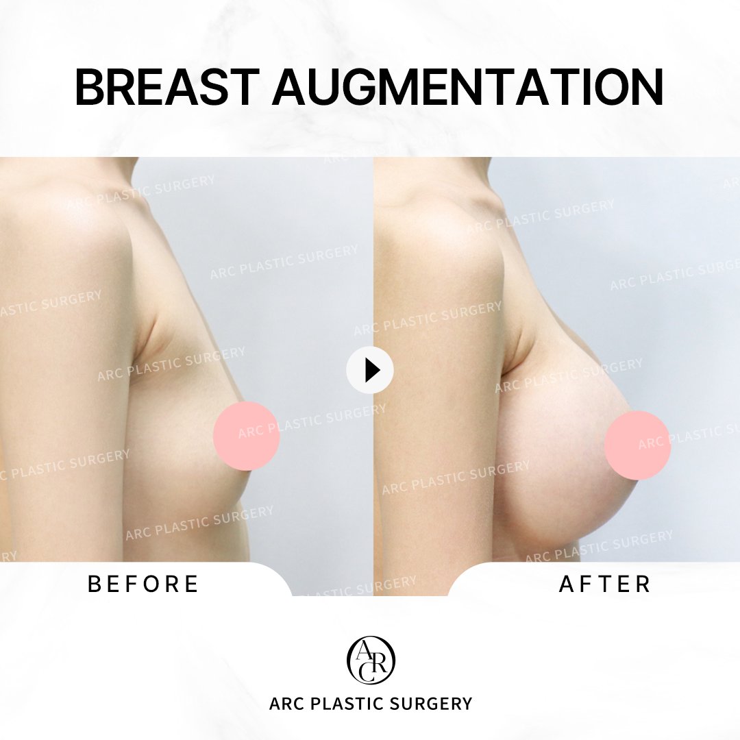 dr_kwonsoonbeom's tweet photo. [FINE ARC]
Breast Augmentation Surgery
***********
Mentor Classic Smooth Implant
: High Profile
- Both) 325cc
- Axillary incision
***********
#arcplasticsurgery #drkwonsoonbeom #breastsurgery #breastaugmentation #Mentorsmooth https://t.co/EXFZ4cjmva