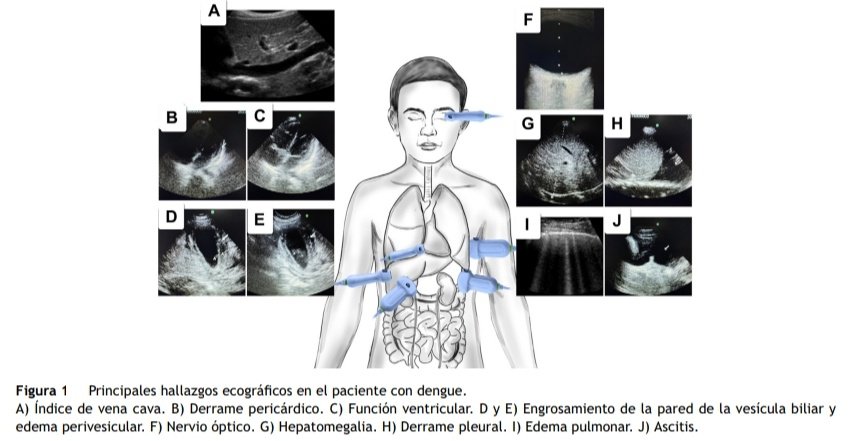 Utilidad de la Ecografía en Pacientes con Dengue 🦟📱

🔰📚Acta Colombiana de Cuidado Intensivo 2024

doi.org/10.1016/j.acci…

Enlace a Artículo Completo 👇🏼✅🆓t.me/SoMELaguna