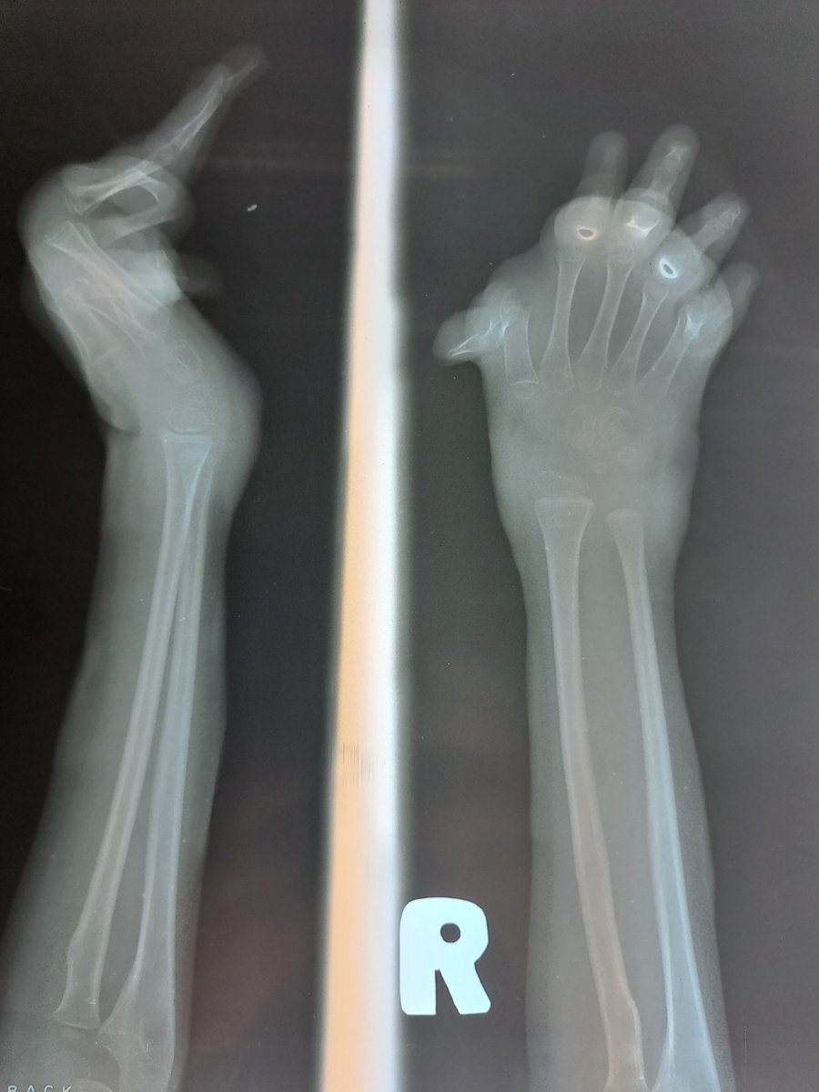 BSSH Cambodia Update Day 1
Our team of hand surgeons, trainees, and a hand therapist arrived in Phnom Penh to a packed waiting room. The CSC team had cases ready for us, making for a busy week of clinics, surgeries, and training.

Stay tuned for more updates!  <a href="/BFIRSTraining/">BFIRST</a>