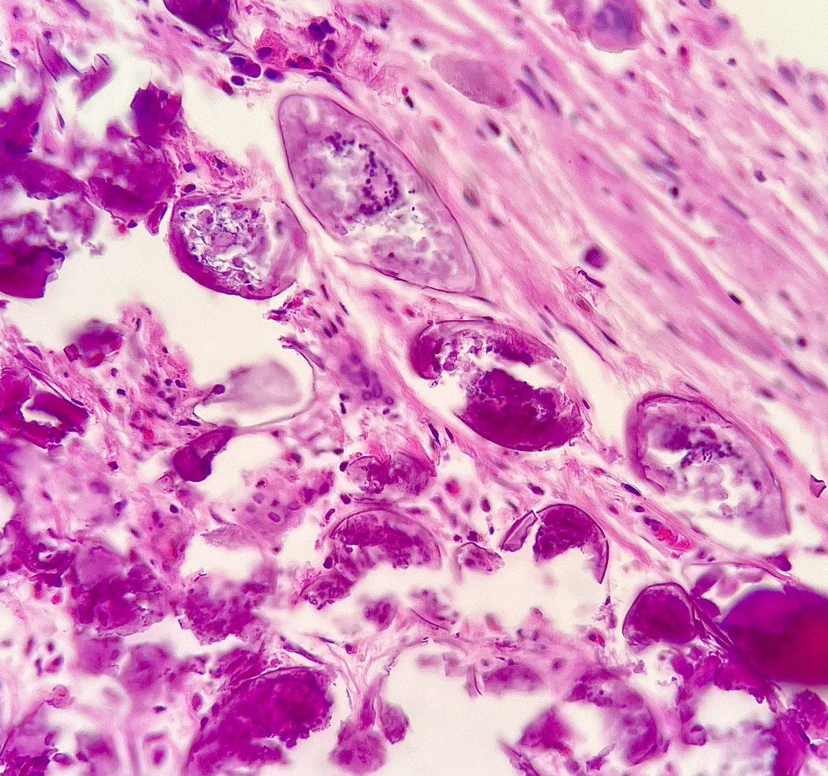 A biopsy of Schistosomiasis with an incidental finding of bladder wall… #PathX #PathTwitter #Crittersontwitter