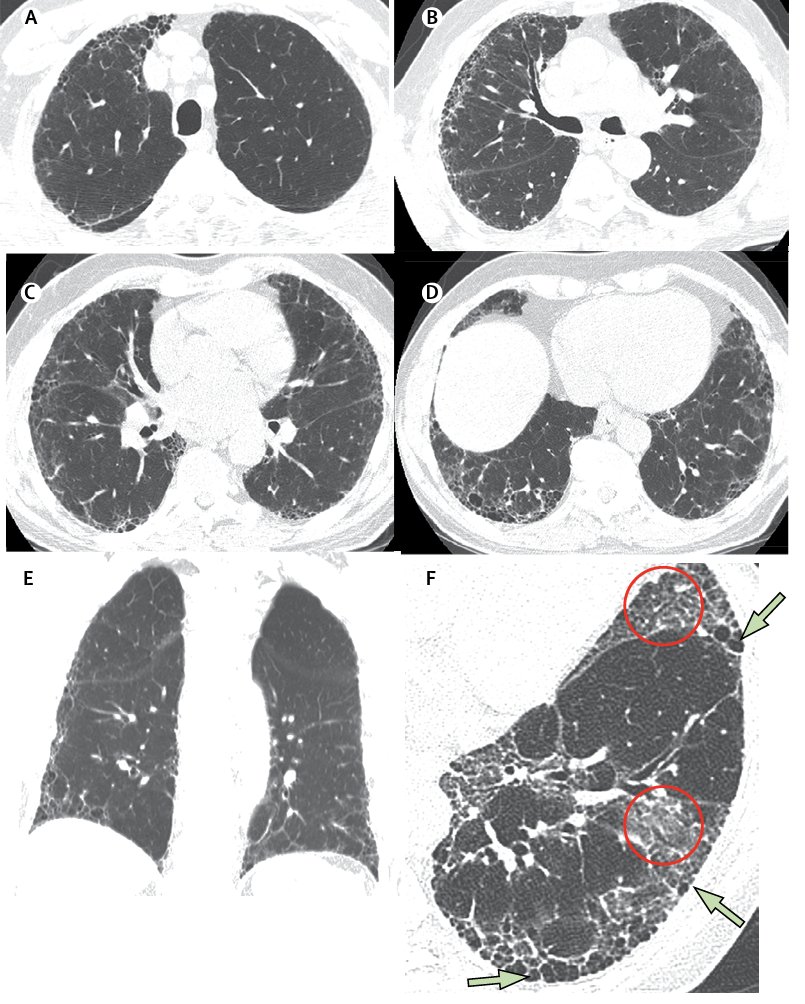 Drbastimd's tweet photo. 🤖 ¡Hola a todos! vamos a desglosar el artículo "Criterios Diagnósticos para la Fibrosis Pulmonar Idiopática" publicado en @TheLancet. ¿Sabías que la TC puede diagnosticar FPI sin biopsia en algunos casos? ¡Hilo con todos los detalles!🧵 #FOAMrad #MedEd @residentesSERAM https://t.co/FOQsv09czp