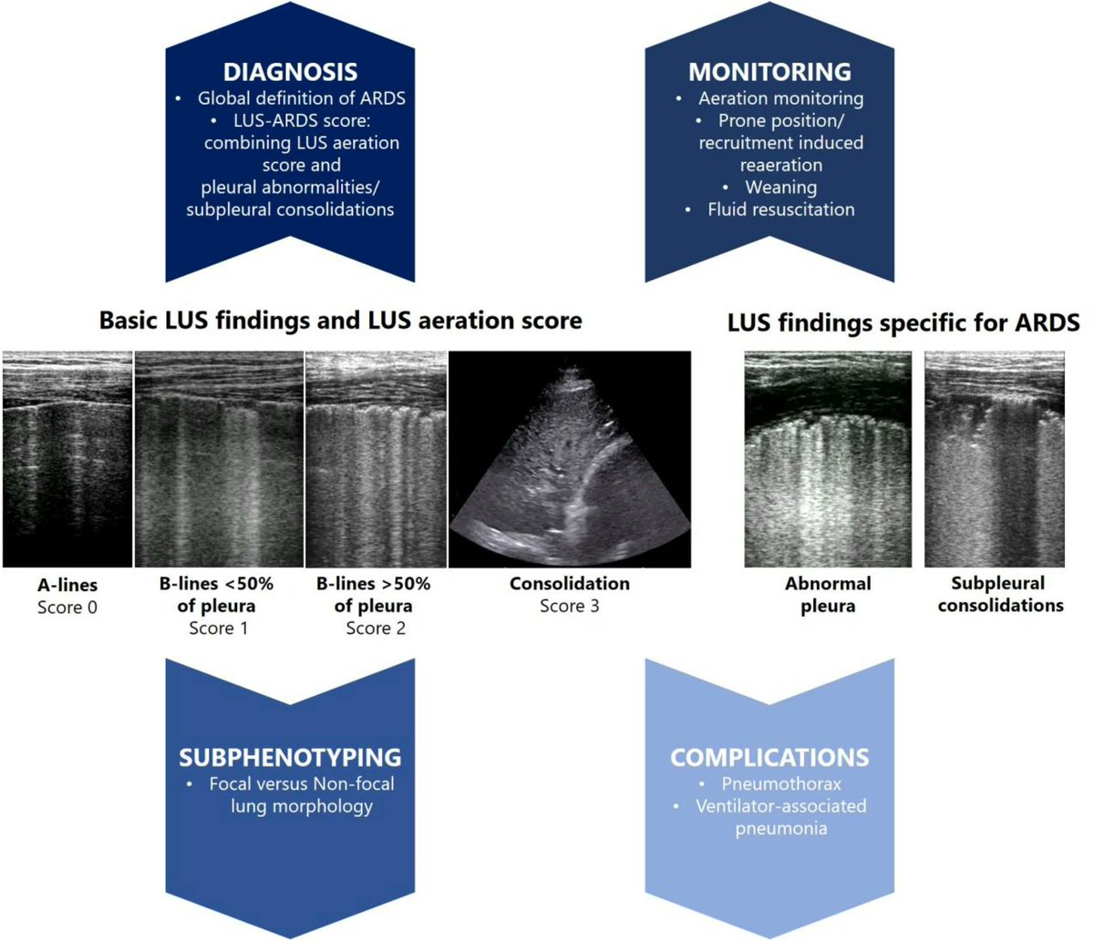 Lung #POCUS for diagnosis and management of #ARDS
#FOAMed #FOAMcc 
🔗link.springer.com/article/10.100…