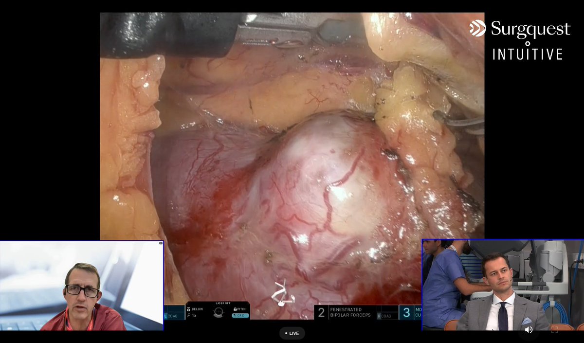 <a href="/Ruben_De_Groote/">Ruben De Groote</a> @sophieknipper <a href="/JochenWalz/">Jochen Walz</a> <a href="/aleantonellibs1/">Alessandro Antonelli MD FRCS(Glasg)</a> <a href="/orsiacademy/">Orsi Academy</a> <a href="/agalfano/">Antonio Galfano</a> <a href="/minerviniandre/">Andrea Minervini</a> <a href="/camilleberquin/">Camille Berquin</a> Get ready for our next livestream!🌟 We’re exploring RAPN with a retroperitoneal approach. Watch @BenChallacombe demonstrate Single Port from the UK (semi-live), while @RiccardoSchiav6 showcases Multiport from OLV Aalst. Tune in on our website!