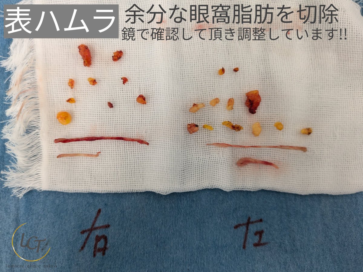 表ハムラ
当院の表ハムラは、眼窩脂肪をただ移動させるのではなく、余分な眼窩脂肪は切除😌仕上がりの感じを患者様に鏡で確認して頂き、不必要なものは微調整をしながら切除しています！
仕上がりの感じを確認しつつ施術できるのがポイント!!✨️満足度が高いです🥹

☏03-6823-0779