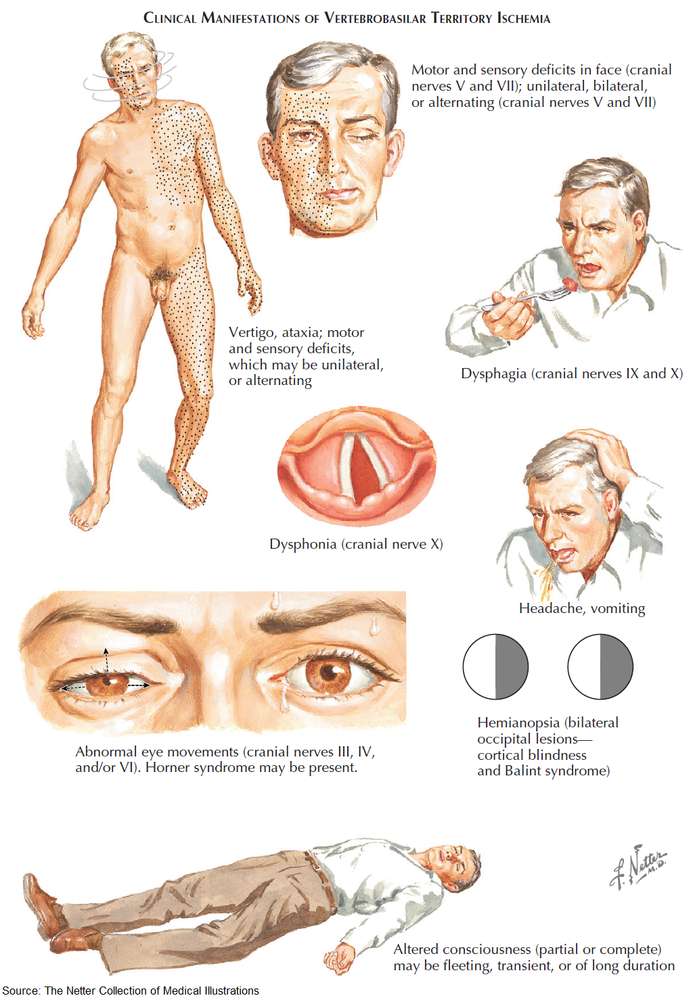 DrAkhilX's tweet image. 🌟 POSTERIOR CIRCULATION STROKE - Clinical Manifestations