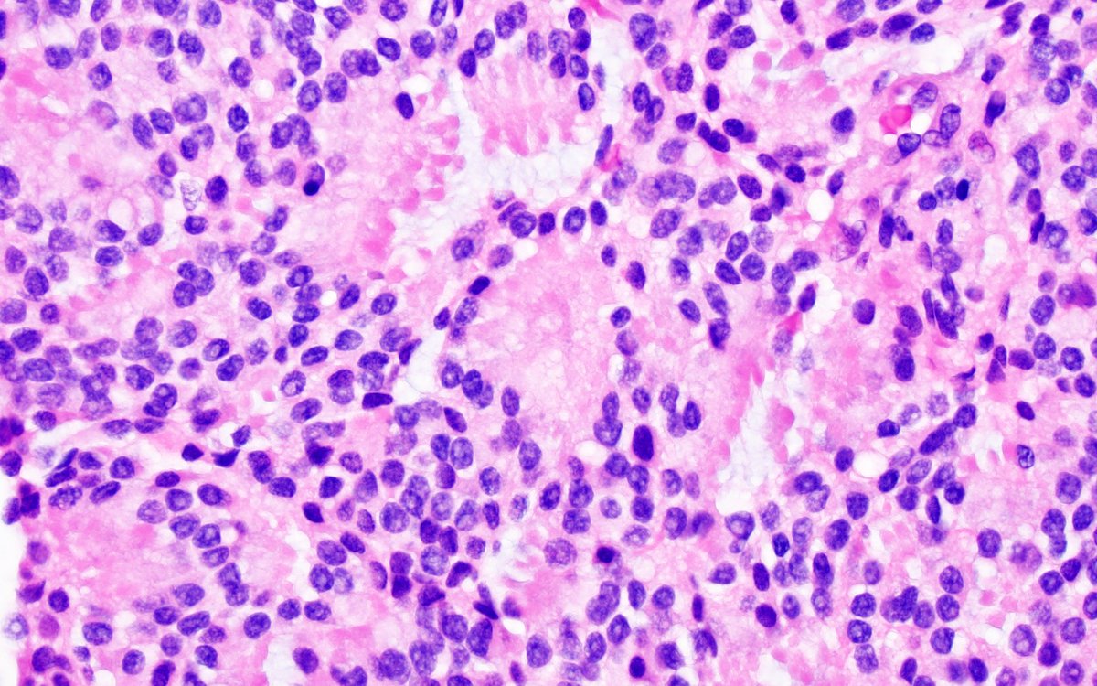 CuringN's tweet photo. CNS & pituitary tumors - What's your diagnosis?
Topic link: https://t.co/vbVLOoRIxV
Images contributed by Jared T. Ahrendsen, M.D., Ph.D., Nitin R. Wadhwani, M.D. and Rachel A. Multz, M.D.
#Cancer #CancerResearch #CuringCancerNetwork #Pathology https://t.co/k753Z0detl