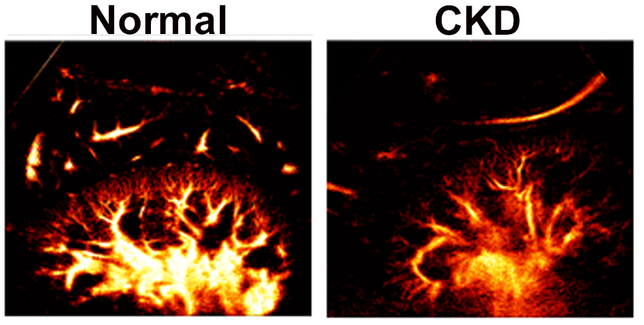 Rod Tan (@rodtan07) on Twitter photo Take a look at our work published in AJKD on the use of super-resolution ultrasound to examine the loss of renal vascularity in CKD patients! Our work was supported by <a href="/pittkidneyctr/">Univ of Pitt Center for Kidney Research</a> and <a href="/nkf/">National Kidney Foundation</a> and <a href="/PittDeptofMed/">PittDeptofMed</a>
authors.elsevier.com/a/1jvuDz-QWLWmJ Take a look at our work published in AJKD on the use of super-resolution ultrasound to examine the loss of renal vascularity in CKD patients! Our work was supported by <a href="/pittkidneyctr/">Univ of Pitt Center for Kidney Research</a> and <a href="/nkf/">National Kidney Foundation</a> and <a href="/PittDeptofMed/">PittDeptofMed</a>
authors.elsevier.com/a/1jvuDz-QWLWmJ