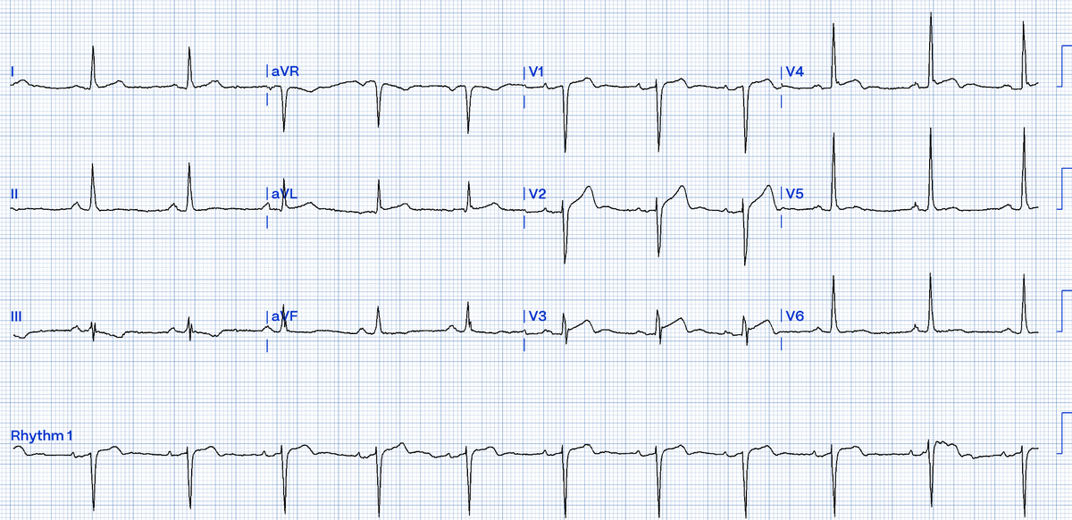 Cath Lab occupied. Which patient should go now (or does only one need it? Or neither?)

hqmeded-ecg.blogspot.com/2024/10/cath-l…