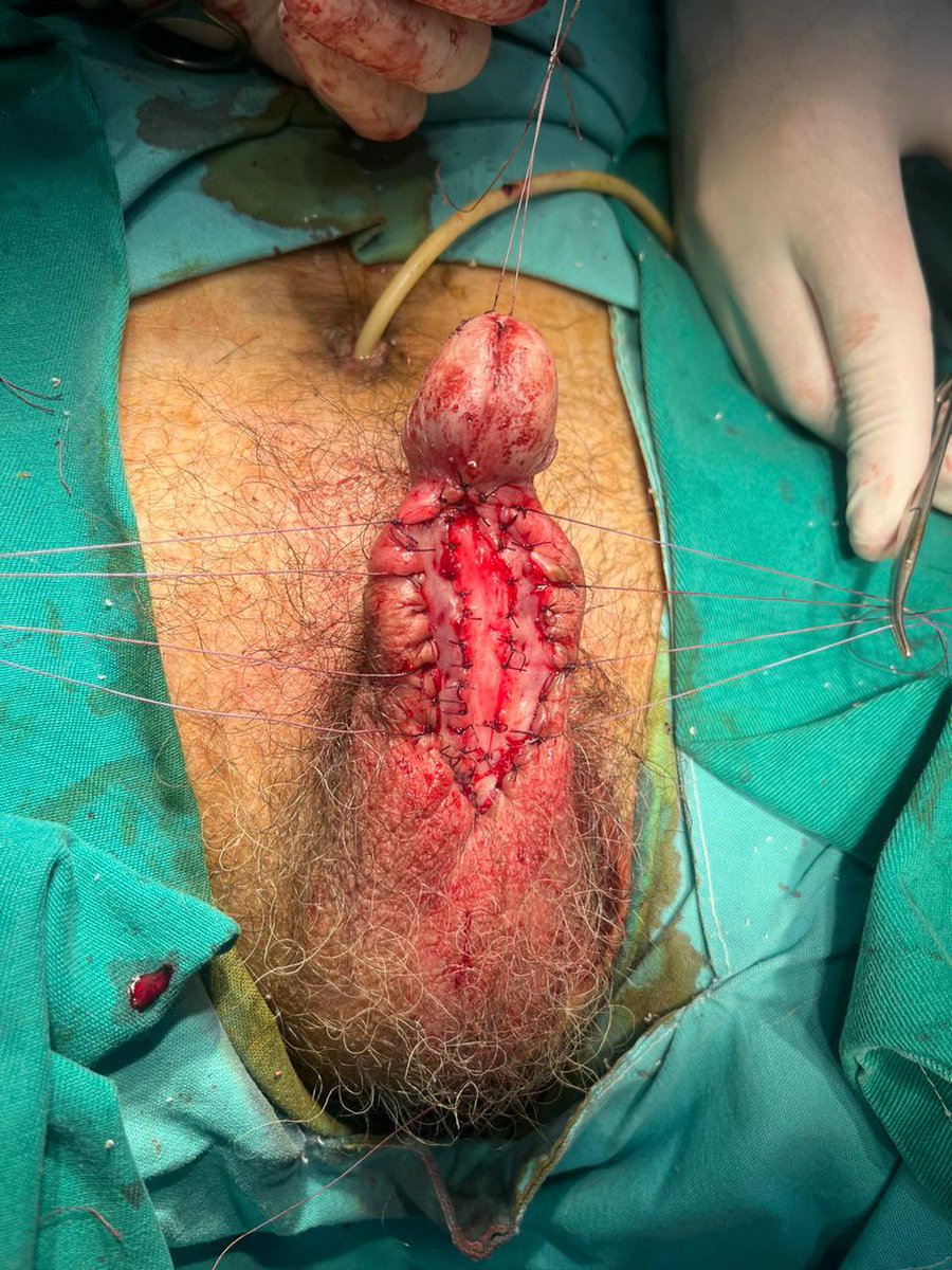 MauroMMeo's tweet photo. 67 yo patient. Urethral stricture secondary to TURBT and subsequent multiple dilations. A poor-quality urethral plate was observed, leading to the decision to perform a staged urethroplasty with BMG.

#CCU

@SocietyGURS 
@SauUrologia https://t.co/F0Et2cNvO2