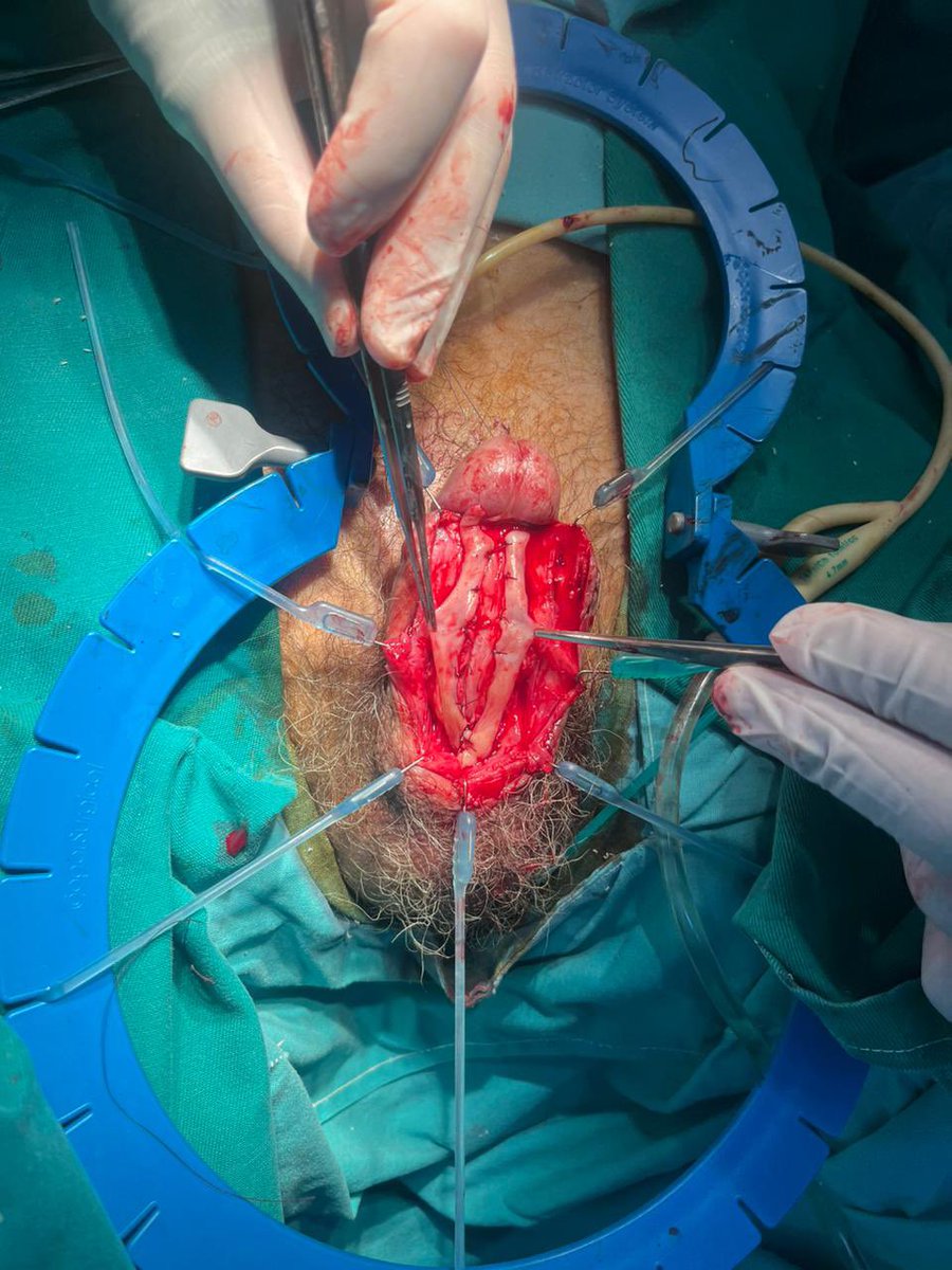 MauroMMeo's tweet photo. 67 yo patient. Urethral stricture secondary to TURBT and subsequent multiple dilations. A poor-quality urethral plate was observed, leading to the decision to perform a staged urethroplasty with BMG.

#CCU

@SocietyGURS 
@SauUrologia https://t.co/F0Et2cNvO2