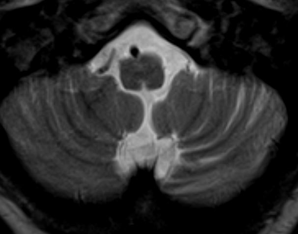 Tip of the day 💡: Even if it is hard to appreciate progressive fronto-insular atrophy in Rasmussen's Encephalitis, look out for similar progressive atrophy in the cerebellum with corresponding diaschisis. There's a clue!