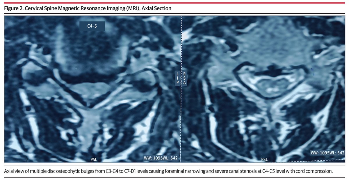 Case report: a novel crossed clonus response in a 48-year-old man with compressive cervical myelopathy. ja.ma/489dOQh