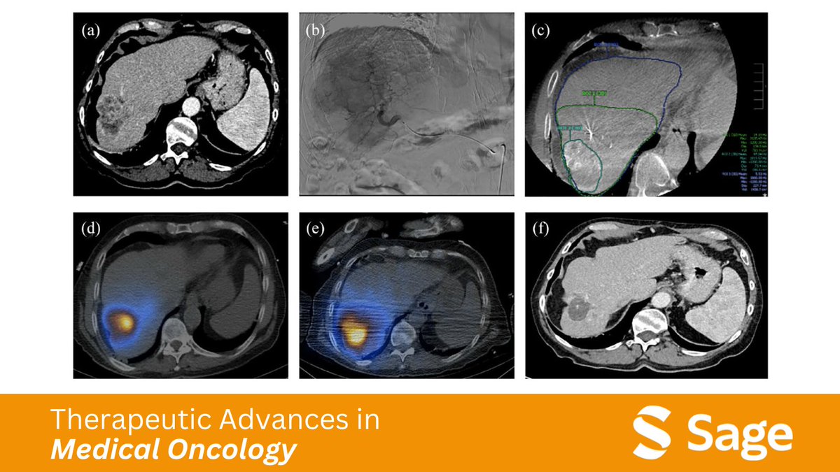 Therapeutic Advances in Medical Oncology (@tamedoncol) on Twitter photo Discover how #Radioembolization is evolving beyond liver tumors! New techniques, including AI-driven dosimetry and applications in prostate and brain cancer, are revolutionizing treatment approaches. 
journals.sagepub.com/doi/epdf/10.11…
#BrainCancer #ProstateCancer #InterventionalRadiology Discover how #Radioembolization is evolving beyond liver tumors! New techniques, including AI-driven dosimetry and applications in prostate and brain cancer, are revolutionizing treatment approaches. 
journals.sagepub.com/doi/epdf/10.11…
#BrainCancer #ProstateCancer #InterventionalRadiology