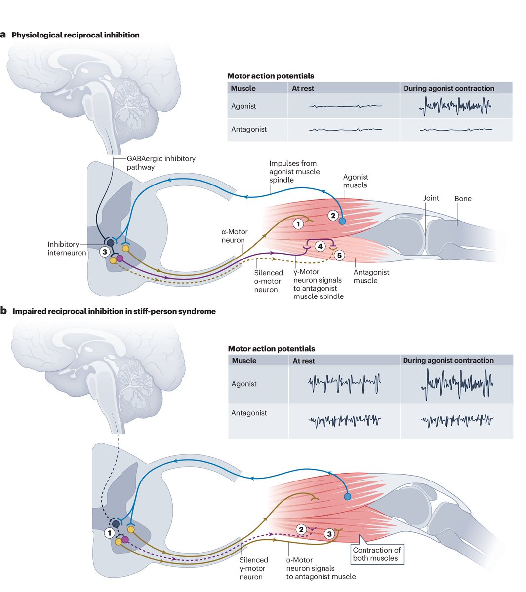 Nature Portfolio (@natureportfolio) on Twitter photo A Review published in <a href="/NatRevNeurol/">Nat Rev Neurology</a> provides an overview of the current clinical and mechanistic understanding of stiff-person syndrome and discusses current and emerging therapeutic interventions.๐
go.nature.com/48dEbVy A Review published in <a href="/NatRevNeurol/">Nat Rev Neurology</a> provides an overview of the current clinical and mechanistic understanding of stiff-person syndrome and discusses current and emerging therapeutic interventions.๐
go.nature.com/48dEbVy