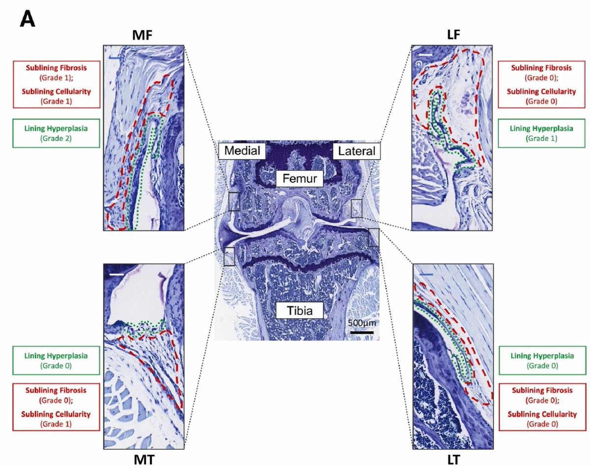👻 #New #BasicScience in #OAC👻
Obeidat et al. suggest a standardized approach for histologic assessment and reporting of synovial pathology in mouse models of OA. @Draliasandoqa @SUNGYEON_KIM
@CARLA_SCANZELLO @AM_MALF @LITTLECB5001
@REM7101
@KEVIN_GBURT
🔗buff.ly/3XM7J7U