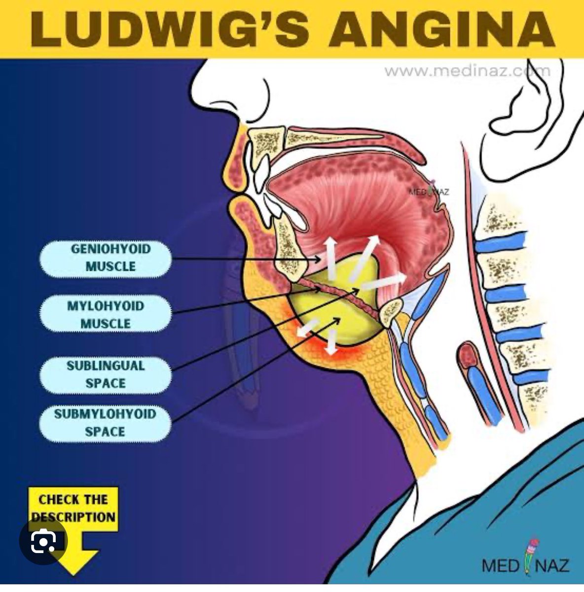 Alqasemi234's tweet photo. @IhabFathiSulima LUDWIG’S ANGINA is life-threatening cellulitis of the soft tissue involving the floor of the mouth and neck. Ludwig angina involves 3 compartments of the floor of the mouth: sublingual, submental, and submandibular. The infection is rapidly progressive, leading to airway obstruct https://t.co/Q3TFHI5cl1