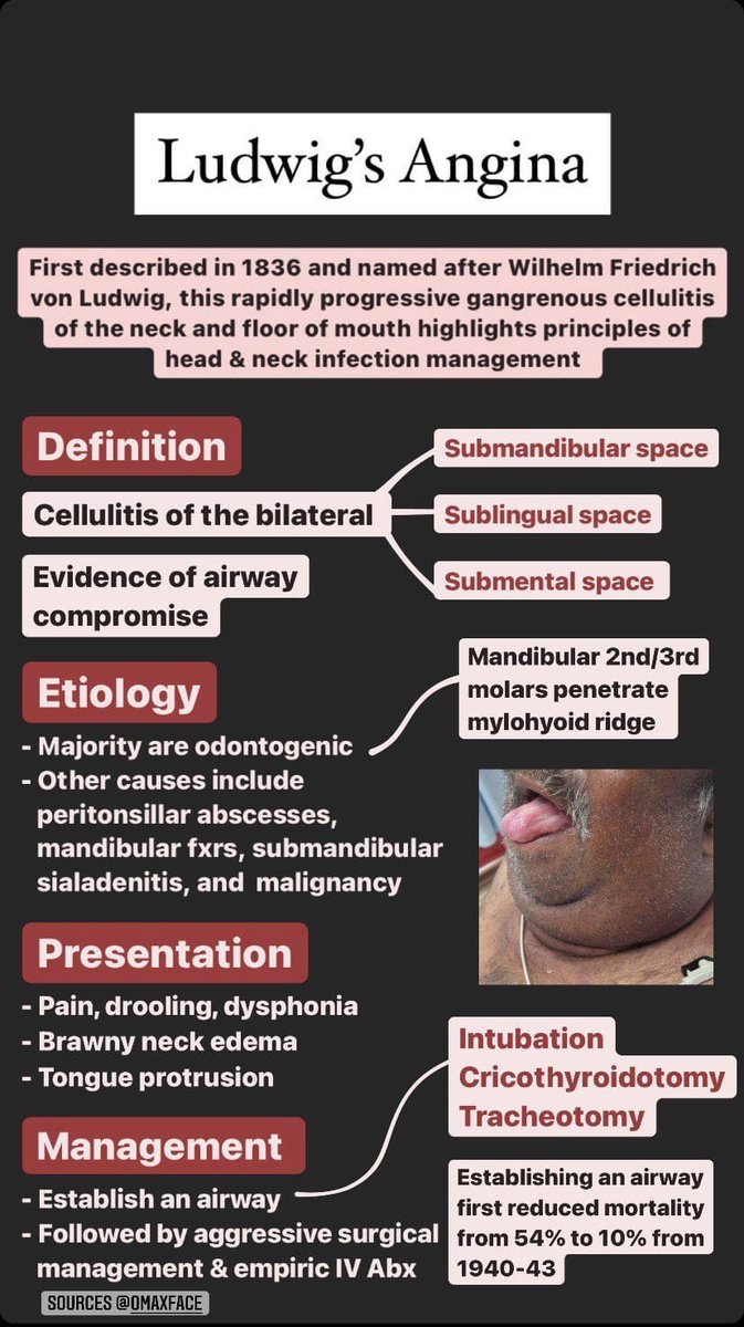 Alqasemi234's tweet photo. @IhabFathiSulima LUDWIG’S ANGINA is life-threatening cellulitis of the soft tissue involving the floor of the mouth and neck. Ludwig angina involves 3 compartments of the floor of the mouth: sublingual, submental, and submandibular. The infection is rapidly progressive, leading to airway obstruct https://t.co/Q3TFHI5cl1