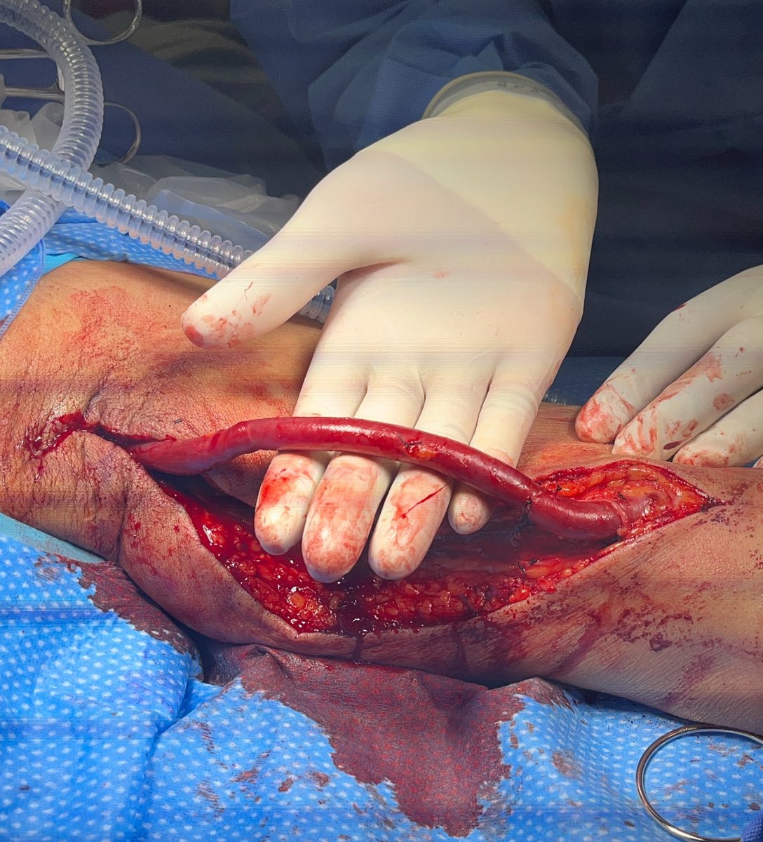 A mature brachiobasilic fistula…took a moment to admire it today. ⁦<a href="/JamaicaHospital/">Jamaica Hospital</a>⁩ ⁦<a href="/FHMC_NYC/">FlushingHospital</a>⁩