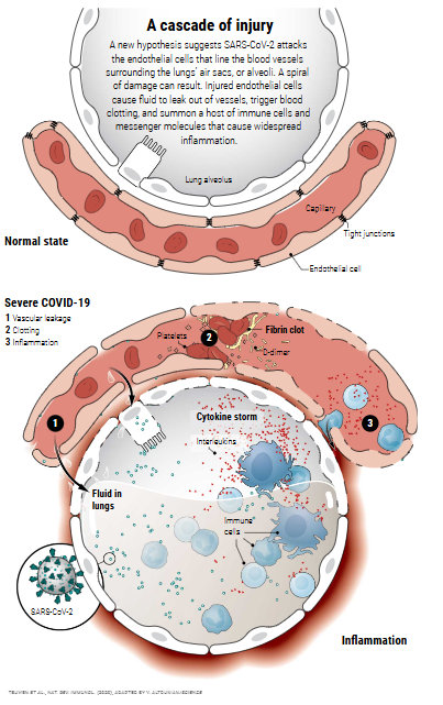 dlingenfelter's tweet photo. COVID-19 may cause severe illness by attacking the endothelial cells that line its victim's blood vessels.

Studies have shown extensive vascular damage and clots in COVID-19 victims, with significantly more clots than those seen in H1N1 flu victims.
https://t.co/nAzwv1cW48 https://t.co/o9MmYHB0DX
