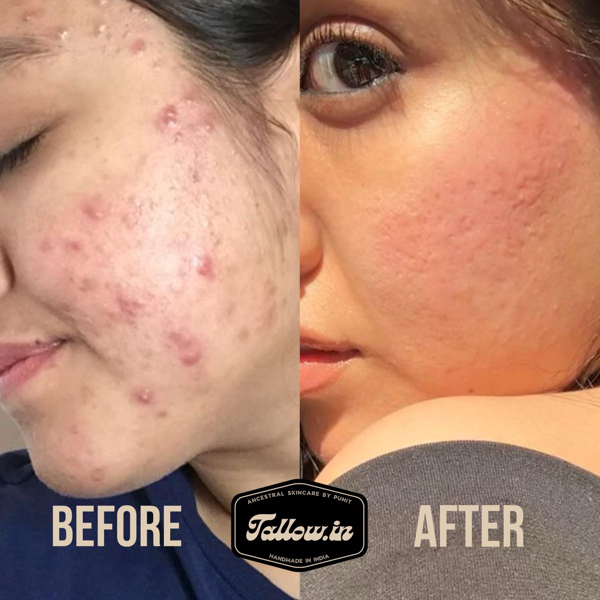 tallowdotin's tweet photo. Tallow Magic for acne-prone skin!
- Soothes inflammation
- Balances skin pH
- Fights acne-causing bacteria
Ditch harsh chemicals, choose natural! #TallowMagic
Order here - https://t.co/xbL7SQjYHQ