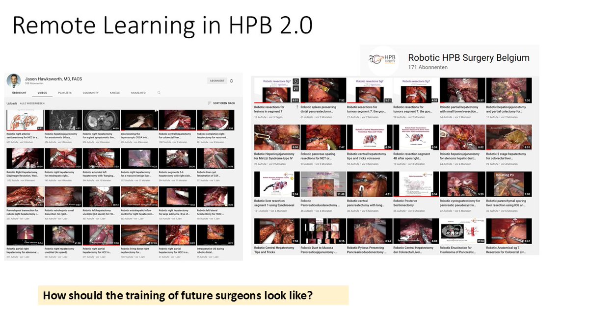 Dana Sochorova (@sochorovadana) on Twitter photo Advantages of 🤖liver surgery discussed at #ESSO43 by <a href="/SStattner/">Shelley Stattner</a> <a href="/HondtMathieu/">Mathieu D’Hondt MD, PhD</a> <a href="/TorzilliGuido/">GUIDO TORZILLI</a>:
❌ no need for CUSA
🤔 maybe shorter time to adjCHT
✔️ easier vessel dissection
↗️ chance for future salvage hepatectomy - see 👇
<a href="/OncoAlert/">OncoAlert</a> <a href="/nader_nkfrancis/">Nader Francis</a> <a href="/HalletJulie/">Julie Hallet</a> <a href="/ESSOnews/">European Society of Surgical Oncology (ESSO)</a> Advantages of 🤖liver surgery discussed at #ESSO43 by <a href="/SStattner/">Shelley Stattner</a> <a href="/HondtMathieu/">Mathieu D’Hondt MD, PhD</a> <a href="/TorzilliGuido/">GUIDO TORZILLI</a>:
❌ no need for CUSA
🤔 maybe shorter time to adjCHT
✔️ easier vessel dissection
↗️ chance for future salvage hepatectomy - see 👇
<a href="/OncoAlert/">OncoAlert</a> <a href="/nader_nkfrancis/">Nader Francis</a> <a href="/HalletJulie/">Julie Hallet</a> <a href="/ESSOnews/">European Society of Surgical Oncology (ESSO)</a>