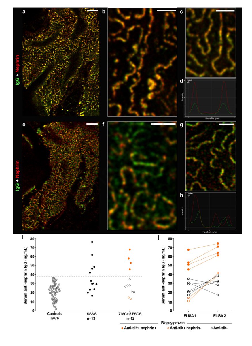 Our new study is out! By STED microscopy on kidney biopsy and ELISA assays we show 1/3 of pediatric and half of adult patients (more in primary FSGS) have autoantibodies against slit antigens different from nephrin. i.e. anti-slit Abs
 kidney-international.org/action/showPdf…