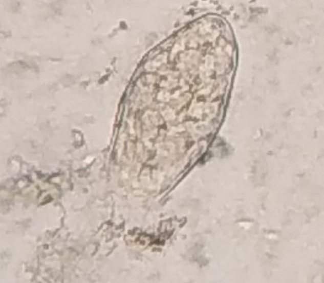 Fasciola again at ID Department. IPGME&amp;R,  3rd in 3 months.