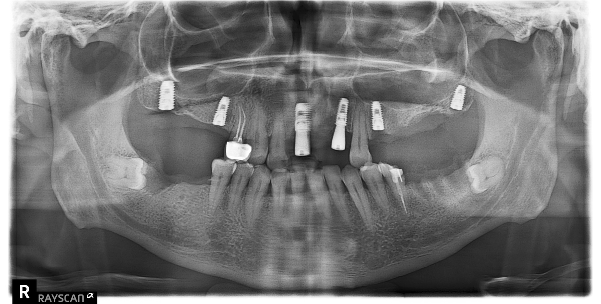 Maxilla ( Önder Çalışkan ) tweet media