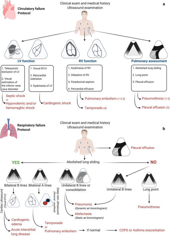 Bedside #POCUS during ward emergencies is associated with improved diagnosis and outcome.
#FOAMed #FOAMcc
🔗 ccforum.biomedcentral.com/articles/10.11…
(*lung point should correspond to abolished lung sliding arm of the figure)