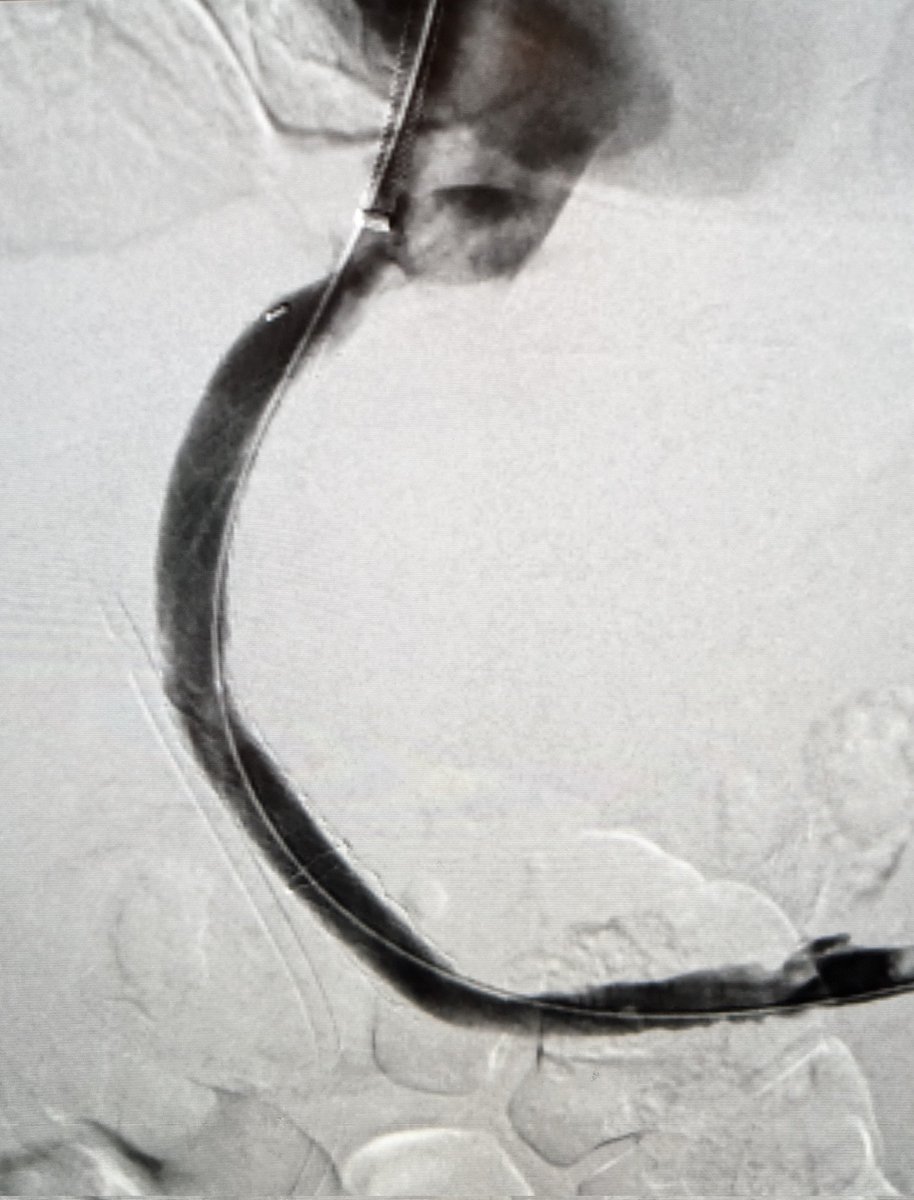 Mark Lessne, MD (@lessnevir) on Twitter photo I do a fair number of #PVRTIPS and this one *almost* bested me!
But got it done and my reward: pt was transplanted!! ❤️
My transplant colleagues are THE BEST!
#NoRetreatNoSurrender #IRad #liver
<a href="/SIRspecialists/">Society of Interventional Radiology</a> <a href="/saherssabri/">Saher Sabri</a> <a href="/MerveOzenMD/">Merve Ozen</a> <a href="/VinceCasingal/">Vince Casingal</a> I do a fair number of #PVRTIPS and this one *almost* bested me!
But got it done and my reward: pt was transplanted!! ❤️
My transplant colleagues are THE BEST!
#NoRetreatNoSurrender #IRad #liver
<a href="/SIRspecialists/">Society of Interventional Radiology</a> <a href="/saherssabri/">Saher Sabri</a> <a href="/MerveOzenMD/">Merve Ozen</a> <a href="/VinceCasingal/">Vince Casingal</a>