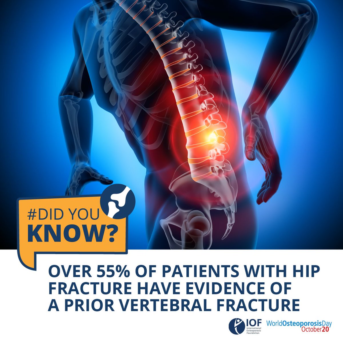 #DidYouKnow One fracture leads to another. Yet, it’s estimated that only 1/3 of vertebral (#spine) fractures come to clinical attention. That’s a missed opportunity to halt a cycle of recurring fractures, including life-threatening hip fractures in later life.