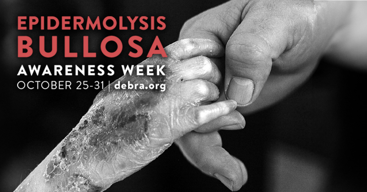 KrystalBiotech's tweet photo. Throughout the year and especially during #EBAwarenessWeek, Krystal Biotech recognizes and supports all those impacted by #EB. 
#EBWeek #EpidermolysisBullosa https://t.co/z9BmKiShH9