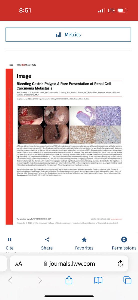 GW Gastroenterology Fellowship (@gw_gastro) on Twitter photo Great job on this case report team! Bleeding gastric polyps found to be RCC Mets… not your typical gastric polyp. <a href="/SumonaB_MD/">Sumona Bhattacharya, MD</a> <a href="/AdamMJacob/">Adam M. Jacob, DO</a> <a href="/ReidSchalet1/">Reid Schalet</a> <a href="/AmCollegeGastro/">ACG</a> <a href="/GWHospital/">GWHospital</a> <a href="/GWSMHS/">GW SMHS</a> <a href="/AmJGastro/">AJG - The American Journal of Gastroenterology</a> Great job on this case report team! Bleeding gastric polyps found to be RCC Mets… not your typical gastric polyp. <a href="/SumonaB_MD/">Sumona Bhattacharya, MD</a> <a href="/AdamMJacob/">Adam M. Jacob, DO</a> <a href="/ReidSchalet1/">Reid Schalet</a> <a href="/AmCollegeGastro/">ACG</a> <a href="/GWHospital/">GWHospital</a> <a href="/GWSMHS/">GW SMHS</a> <a href="/AmJGastro/">AJG - The American Journal of Gastroenterology</a>