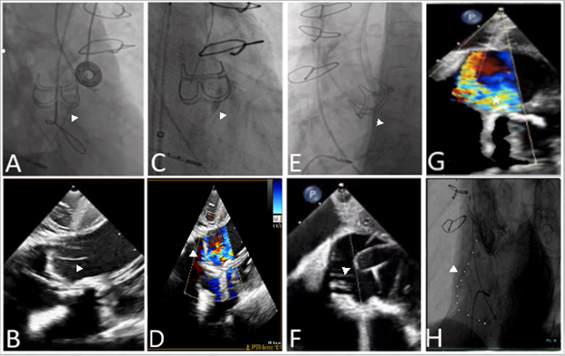 Journal of Invasive Cardiology tweet media