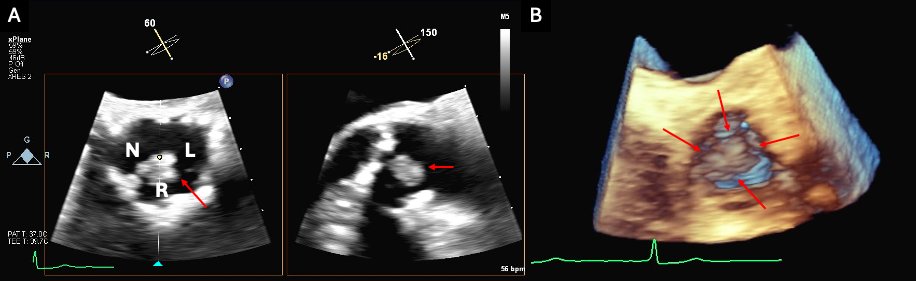 Journal of Invasive Cardiology tweet media