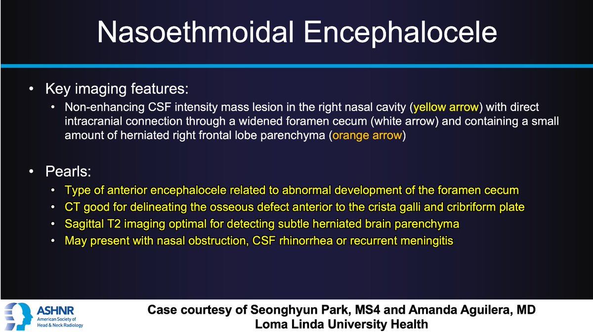ASHNR (@ashnrsociety) on Twitter photo #ASHNRCOTW #271: ANSWER. Thx Seonghyun Park +
<a href="/AAguilera_MD/">Amanda Aguilera, MD</a> 4 case! #ASHNR24
<a href="/callyrobs/">Caroline Robson, MBChB</a> <a href="/DShatzkes/">Deborah Shatzkes</a> <a href="/CDP_Rad/">C Douglas Phillips 🇺🇸</a> <a href="/rhwiggins/">Richard Wiggins</a> <a href="/nakoontz/">Nicholas Koontz</a> <a href="/KRileyMD/">Kalen Riley</a> <a href="/CMGlastonbury/">Christine M Glastonbury, MD</a> <a href="/tabby_kennedy/">Tabby A. Kennedy, MD</a> <a href="/PhilipRChapman1/">Philip R. Chapman, MD</a> @MohitAgNeurorad <a href="/AshokSrini15/">Ashok Srinivasan</a> <a href="/WmOBrienDO/">William T. O'Brien, DO 🧠🩻</a> <a href="/RadRupa/">Rupa Radhakrishnan</a> @ashasarm #ASHNRCOTW #271: ANSWER. Thx Seonghyun Park +
<a href="/AAguilera_MD/">Amanda Aguilera, MD</a> 4 case! #ASHNR24
<a href="/callyrobs/">Caroline Robson, MBChB</a> <a href="/DShatzkes/">Deborah Shatzkes</a> <a href="/CDP_Rad/">C Douglas Phillips 🇺🇸</a> <a href="/rhwiggins/">Richard Wiggins</a> <a href="/nakoontz/">Nicholas Koontz</a> <a href="/KRileyMD/">Kalen Riley</a> <a href="/CMGlastonbury/">Christine M Glastonbury, MD</a> <a href="/tabby_kennedy/">Tabby A. Kennedy, MD</a> <a href="/PhilipRChapman1/">Philip R. Chapman, MD</a> @MohitAgNeurorad <a href="/AshokSrini15/">Ashok Srinivasan</a> <a href="/WmOBrienDO/">William T. O'Brien, DO 🧠🩻</a> <a href="/RadRupa/">Rupa Radhakrishnan</a> @ashasarm