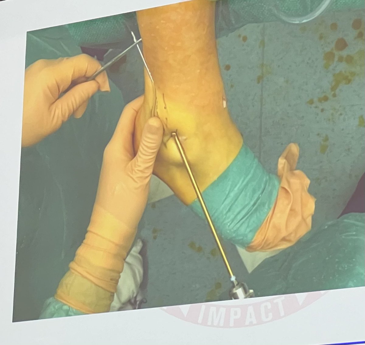 Dr Andrew Mitchell (@acs_mitchell) on Twitter photo Fascinating session <a href="/IAS10_2024/">IAS10_2024</a> from Dr Ronny Lopes, Dr Adrien Ray & De Stéphane Guillo on innovative surgical approaches of lateral ankle reconstruction in elite athletes #IAS_2024 Fascinating session <a href="/IAS10_2024/">IAS10_2024</a> from Dr Ronny Lopes, Dr Adrien Ray & De Stéphane Guillo on innovative surgical approaches of lateral ankle reconstruction in elite athletes #IAS_2024