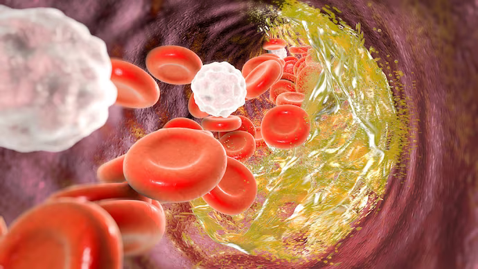 Research shows that patients who continue their cholesterol medication before non-cardiac surgery have better recovery and fewer complications. 🫀

Click to Learn More: 
🔗"Statins in the Perioperative Period" ncbi.nlm.nih.gov/pmc/articles/P…

#MedicalIllumination #CholesterolEducation