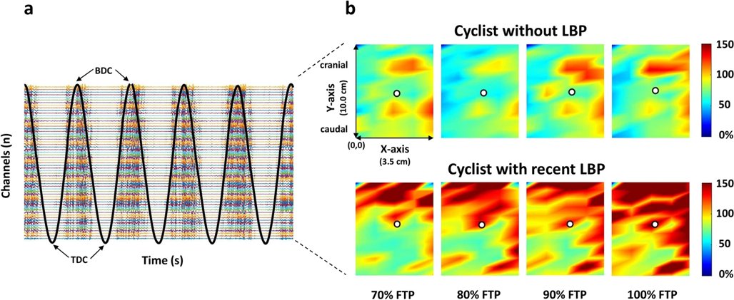 Andrea Casolo (@andrecasolo) on Twitter photo "Alterations in magnitude and spatial distribution of erector spinae muscle activity in cyclists with a recent history of low back pain"
➡️Here are the results of our latest study, published in <a href="/EJAP_official/">European Journal of Applied Physiology</a> (Open access)
link.springer.com/article/10.100…
#lowbackpain #HDsEMG #cycling "Alterations in magnitude and spatial distribution of erector spinae muscle activity in cyclists with a recent history of low back pain"
➡️Here are the results of our latest study, published in <a href="/EJAP_official/">European Journal of Applied Physiology</a> (Open access)
link.springer.com/article/10.100…
#lowbackpain #HDsEMG #cycling