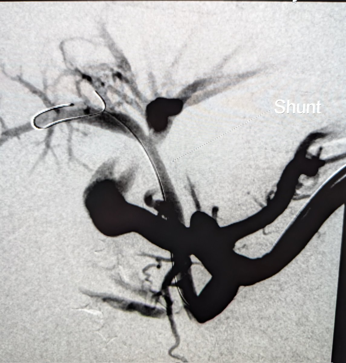 Mark Lessne, MD (@lessnevir) on Twitter photo Transplenic access useful in children too!
Young child w occluded portal and Rex.
Splenic access w 5Fr Halo (4fr equivalent) to recan & restore shunt patency
#IRad <a href="/CHPtransplant/">CHP Transplant</a> <a href="/SIRspecialists/">Society of Interventional Radiology</a> <a href="/MerveOzenMD/">Merve Ozen</a> Transplenic access useful in children too!
Young child w occluded portal and Rex.
Splenic access w 5Fr Halo (4fr equivalent) to recan & restore shunt patency
#IRad <a href="/CHPtransplant/">CHP Transplant</a> <a href="/SIRspecialists/">Society of Interventional Radiology</a> <a href="/MerveOzenMD/">Merve Ozen</a>