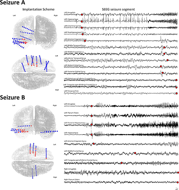 Déjà vu! 🤯 Ever felt like you've seen this patient before?

Taking the first step towards deep #phenotyping 🔍 in #epilepsy surgery with #seizure matching. #EpilepsySurgery #Neurotwitter

🔗doi.org/10.1088/1741-2… 

<a href="/johnthomasphd/">John Thomas, PhD 👨‍💻🧠❓️</a> <a href="/dr_chifa/">Chifaou Abdallah</a> <a href="/Duke_Neurology/">Duke Neurology</a> <a href="/IOPPBio/">IOPPBio</a> <a href="/TheNeuro_MNI/">The Neuro</a>