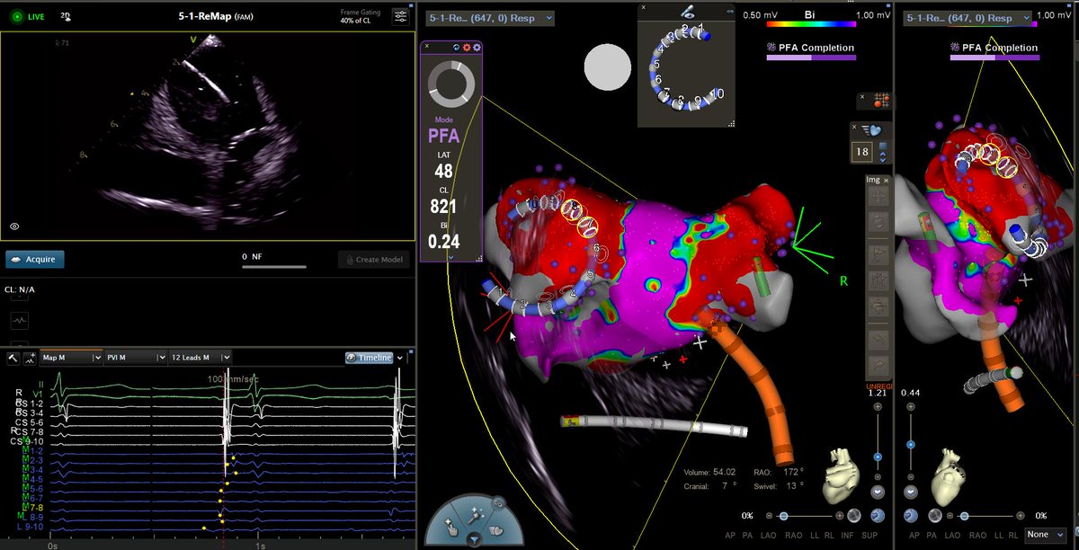 Francisco M. Costa (@moscoso_costa) on Twitter photo Fluoroless AF ablation workflow with CARTOSOUND + Varipulse
#HospitalStaCruz #ICEEyes #Zerofluoro <a href="/cavaco_diogo/">Diogo Cavaco</a> <a href="/danielssagomes/">Daniel Gomes</a> <a href="/Life_activist_/">GustavoRRodrigues</a> <a href="/DanielM891/">Daniel Matos</a> <a href="/cgmarinescu/">Cătălin Marinescu</a> <a href="/JoanaPinho92/">Joana Pinho</a> @claudiojh89 Fluoroless AF ablation workflow with CARTOSOUND + Varipulse
#HospitalStaCruz #ICEEyes #Zerofluoro <a href="/cavaco_diogo/">Diogo Cavaco</a> <a href="/danielssagomes/">Daniel Gomes</a> <a href="/Life_activist_/">GustavoRRodrigues</a> <a href="/DanielM891/">Daniel Matos</a> <a href="/cgmarinescu/">Cătălin Marinescu</a> <a href="/JoanaPinho92/">Joana Pinho</a> @claudiojh89