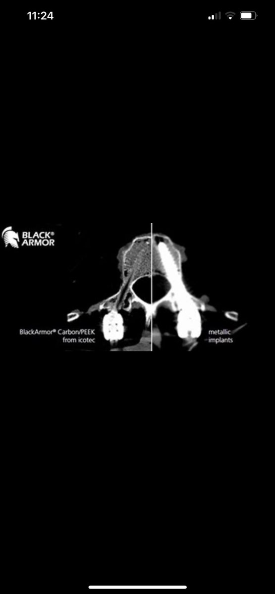 Joshua D. Palmer, MD (@joshuapalmermd) on Twitter photo Carbon fiber instrumentation is significantly better for patients during long term follow up to identify early recurrences. Thanks to our excellent spine team at out <a href="/ChakravarthyMD/">Vikram B. Chakravarthy, MD</a>. link.springer.com/article/10.100…. @OSUNeuroInst <a href="/OSUCCC_James/">The James</a> <a href="/OhioStateRadOnc/">OhioStateRadOnc</a> <a href="/ASTRO_org/">ASTRO</a> Carbon fiber instrumentation is significantly better for patients during long term follow up to identify early recurrences. Thanks to our excellent spine team at out <a href="/ChakravarthyMD/">Vikram B. Chakravarthy, MD</a>. link.springer.com/article/10.100…. @OSUNeuroInst <a href="/OSUCCC_James/">The James</a> <a href="/OhioStateRadOnc/">OhioStateRadOnc</a> <a href="/ASTRO_org/">ASTRO</a>