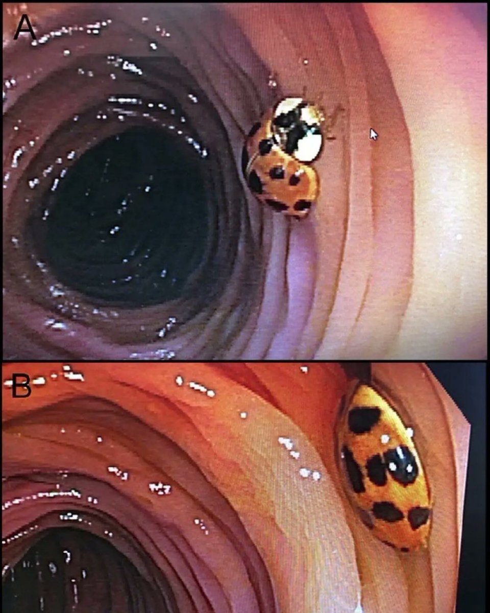 A living ladybug found in someone’s  transverse colon during a colonoscopy 

📸American College of Gatroenterology