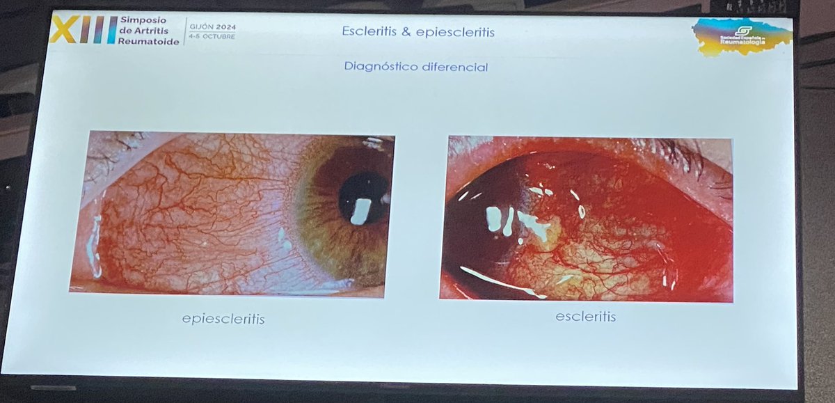 Jesús Sanz (@jesussanzsanz44) on Twitter photo Estamos con la inflamación ocular en #ArtritisReumatoide con <a href="/VanesaCalvoRio/">Vanesa Calvo Río</a>. #SimposioAR24 Estamos con la inflamación ocular en #ArtritisReumatoide con <a href="/VanesaCalvoRio/">Vanesa Calvo Río</a>. #SimposioAR24