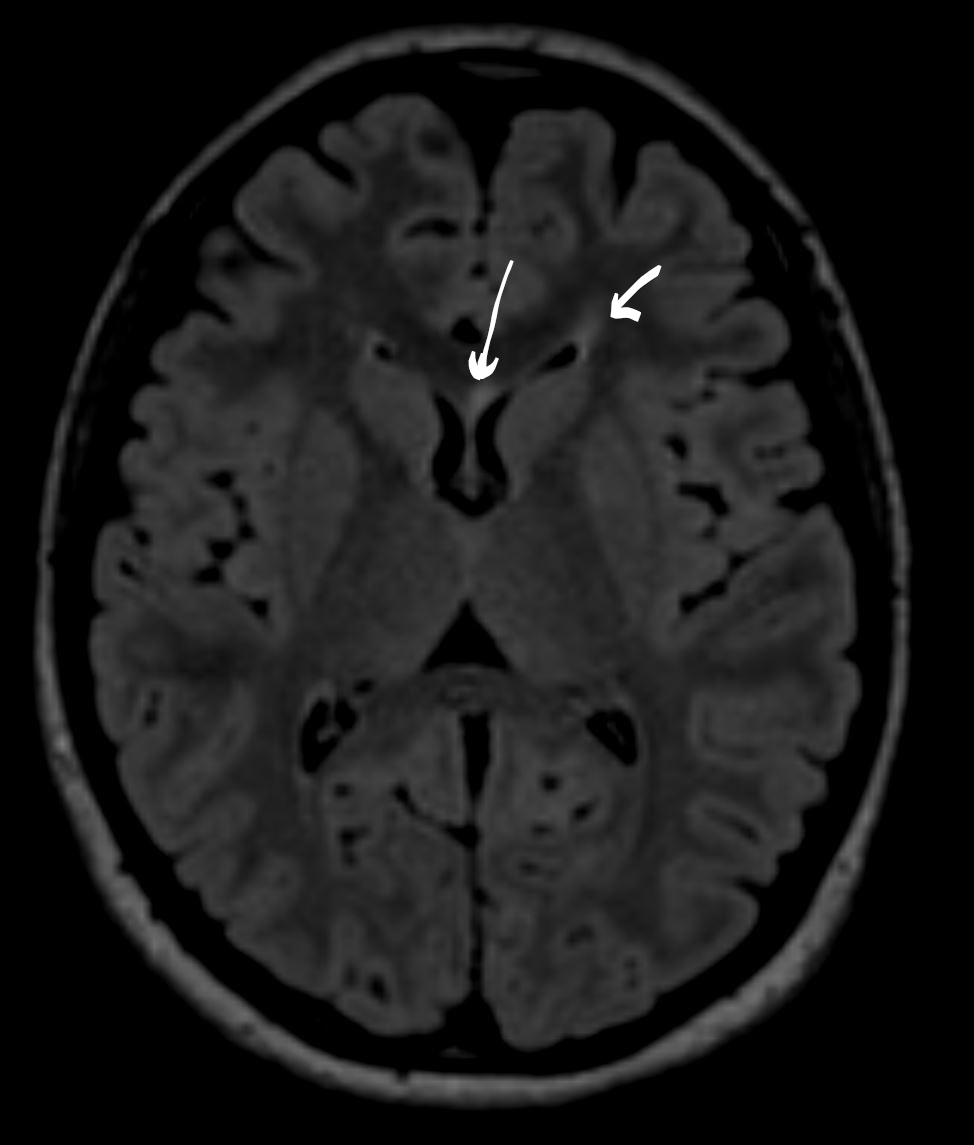 Tip of the day 💡: Volume 3D-FLAIR is the key sequence to detect subtle neuroinflammatory lesions. Hope you are doing this in your centers on a regular basis?
