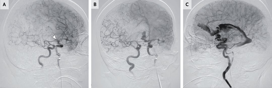 NEJM's tweet photo. Images in Clinical Medicine: Rerupture of an Aneurysmal Subarachnoid Hemorrhage https://t.co/HooEQnCJJP 

#ClinicalMedicine https://t.co/PY9BnCYn3e