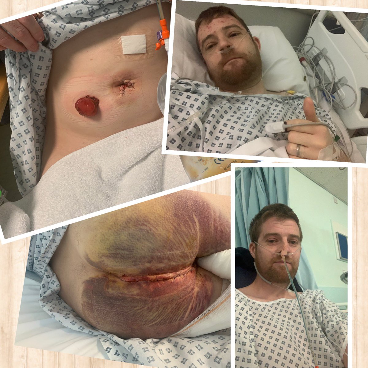 Stoma Awareness Day

Having a stoma is just the norm for me now. Having a bag was the best decision. 

I’m forever grateful to all the staff <a href="/WalsallHcareNHS/">Walsall Healthcare</a> for all they’ve done for me. 

Be proud. 

💩💩💩Bags for life. 💩💩💩

#StomaAware <a href="/CrohnsColitisUK/">Crohn's & Colitis UK</a> <a href="/ColostomyUK/">ColostomyUK</a>
