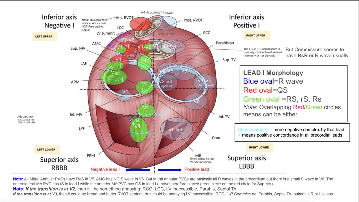 PVC localization diagram. Added my own touches. adapted from the nice figure by Enriquez et al. Illustrates the precordial transitions to positive complexes, lead I morphology (blue/red/green circles), and precordial transition to negative complexes. #EPeeps