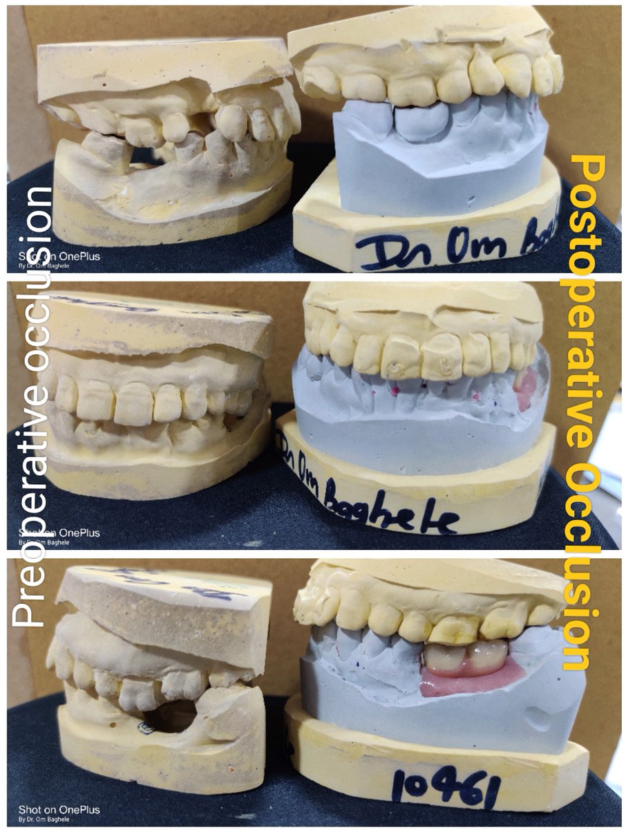 ombaghele's tweet photo. Occlusion or contact between the teeth, or how the upper and lower t ..For more info visit...https://t.co/JsjO6NvfAk: no matching action found for the expression.
   at kitsune.syntaxparser.models.parsetress.parse(node node)/34?utm_source=twitter https://t.co/Kf64PzMZhY
